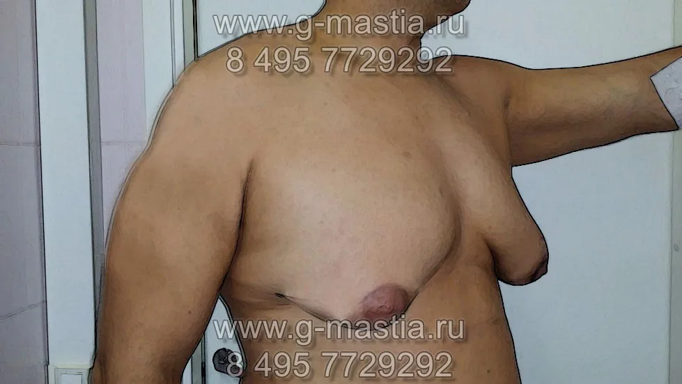 Выраженная форма гинекомастии