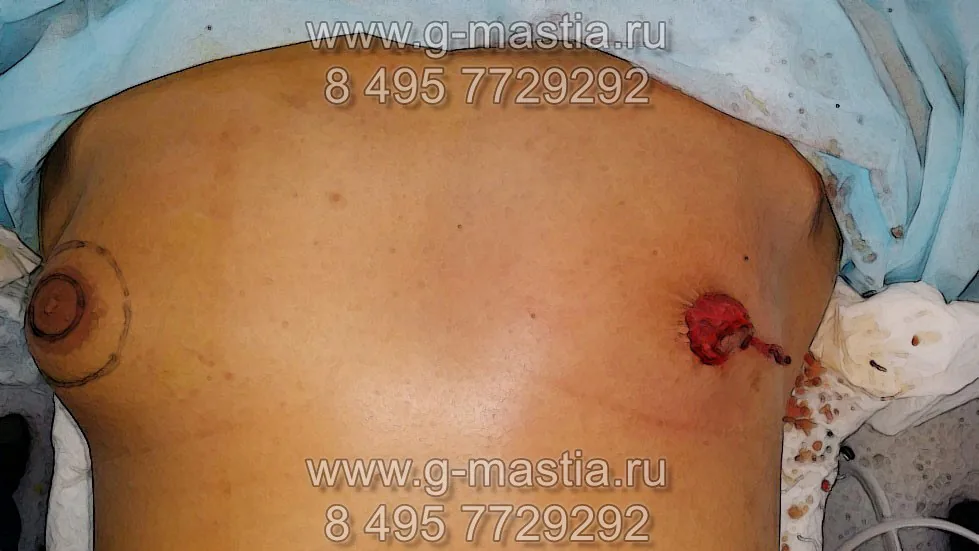 Подтяжка груди при выраженной гинекомастии