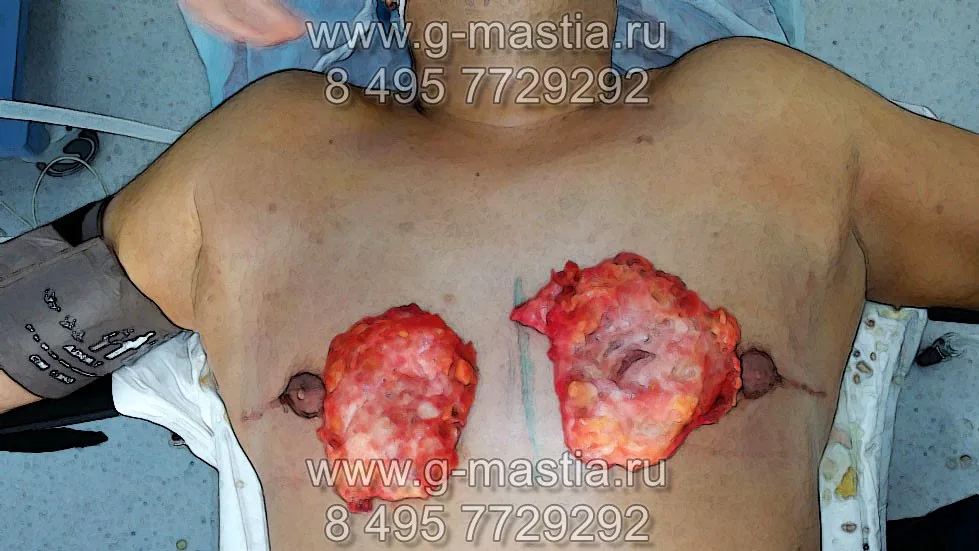 Удалённые грудные железы больших размеров