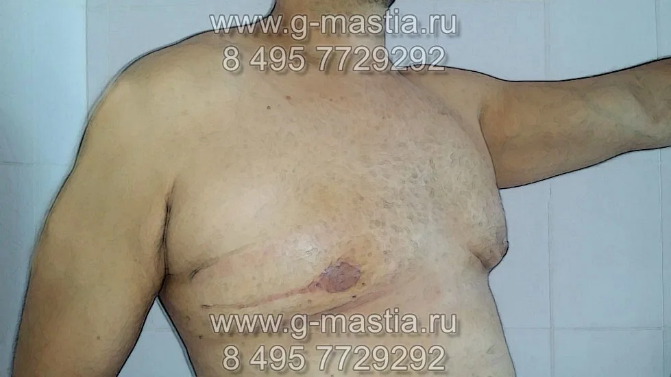 Подтяжка груди при выраженной гинекомастии. Результат операции
