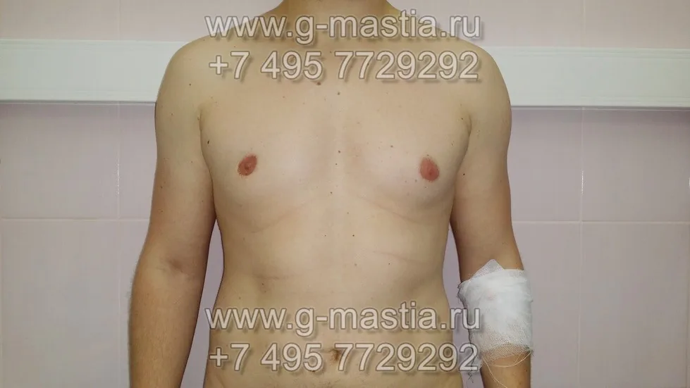 Пластика сосково-ареолярного комплекса