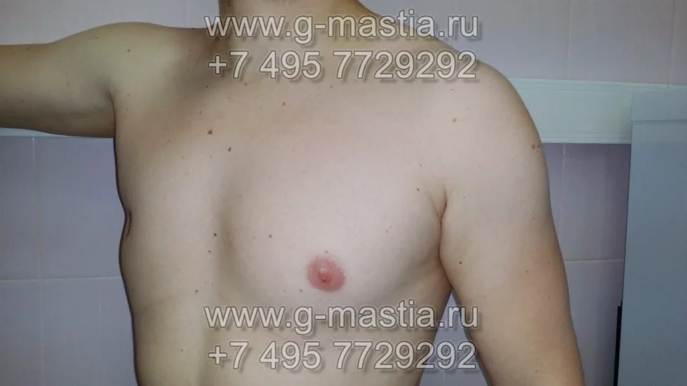 Асимметрия грудной области