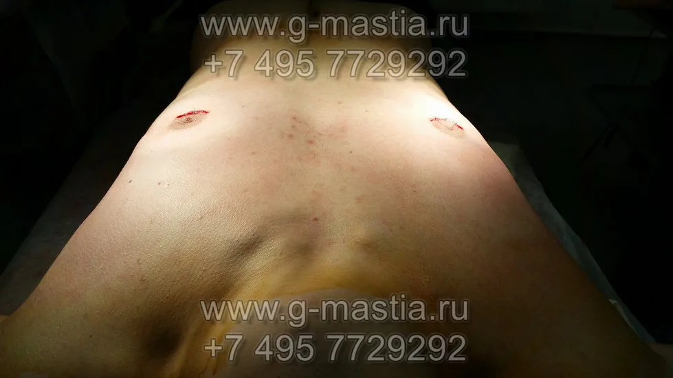 Подкожная мастэктомия. После операции