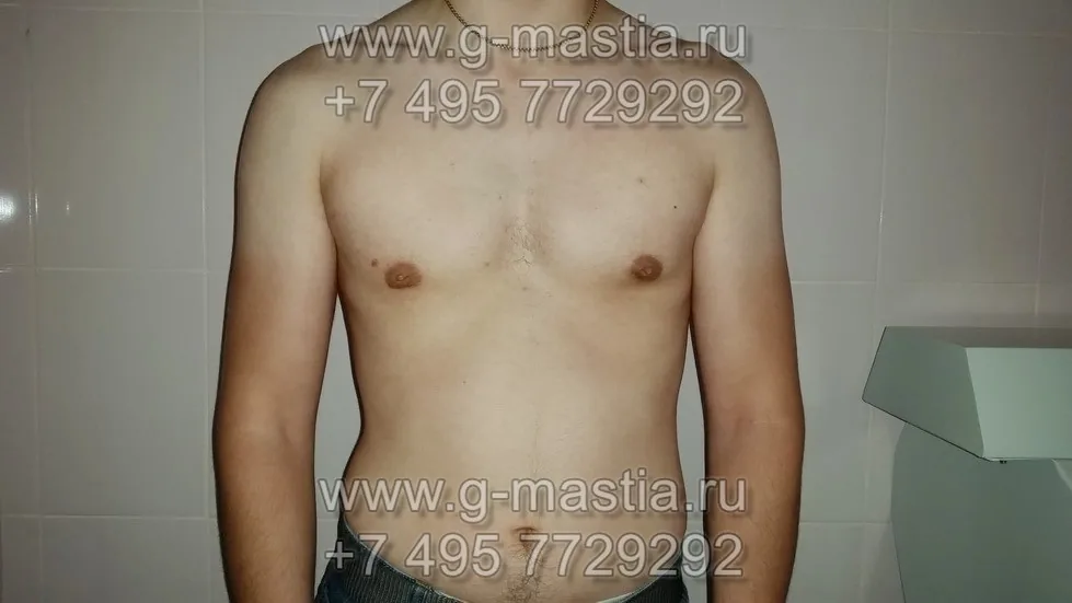 Подкожная мастэктомия. Отдалённый результат операции