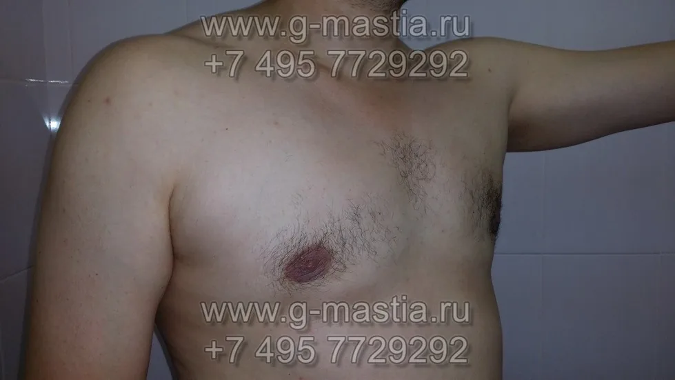 Результат через полгода после операции