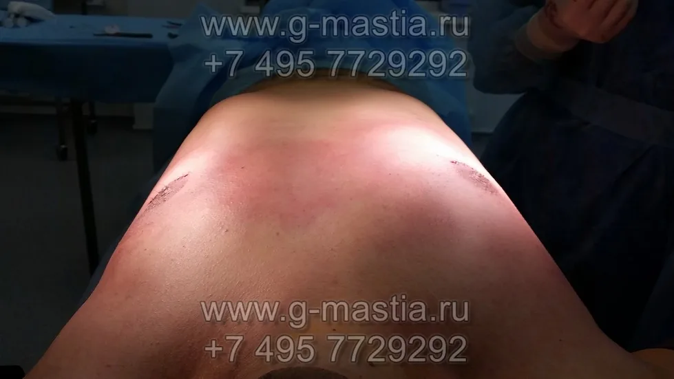На операционном столе сразу после операции