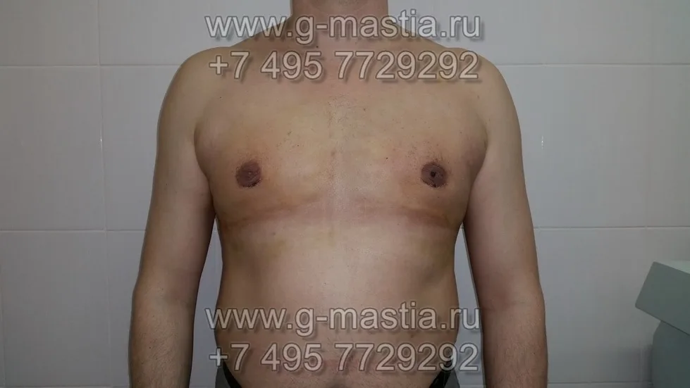 Пациент на снятии швов через 10 дней