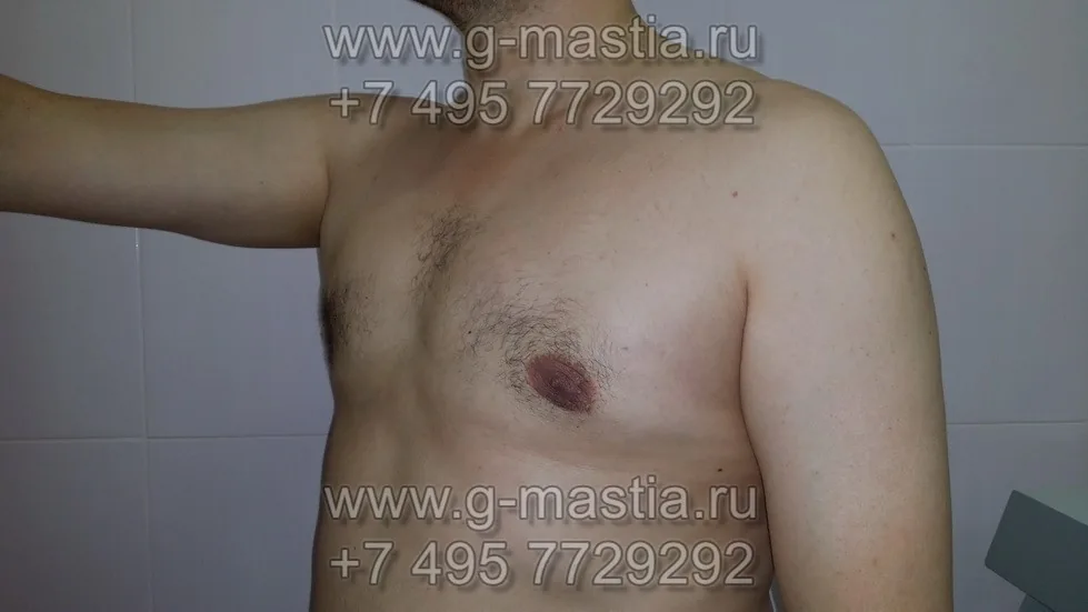 Результат через полгода после операции