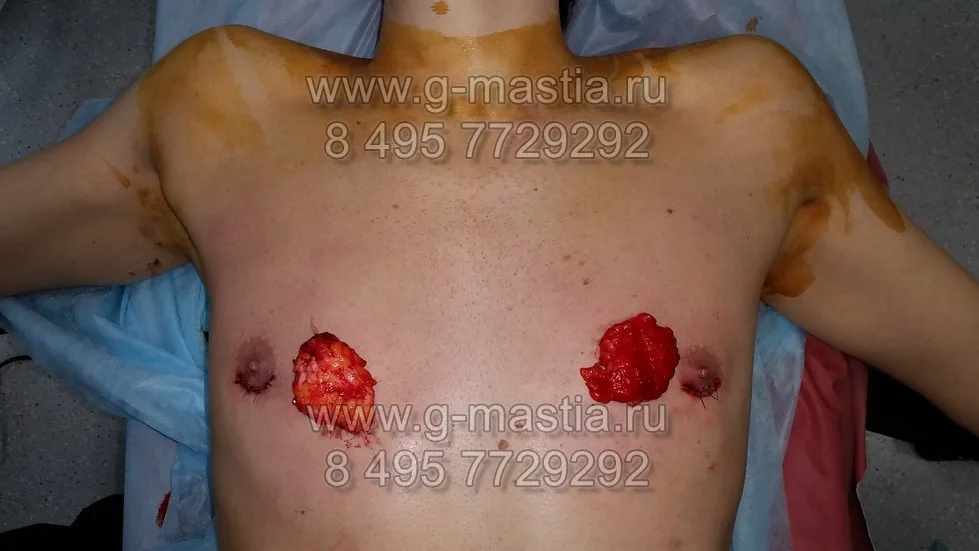 Удалённые грудные железы