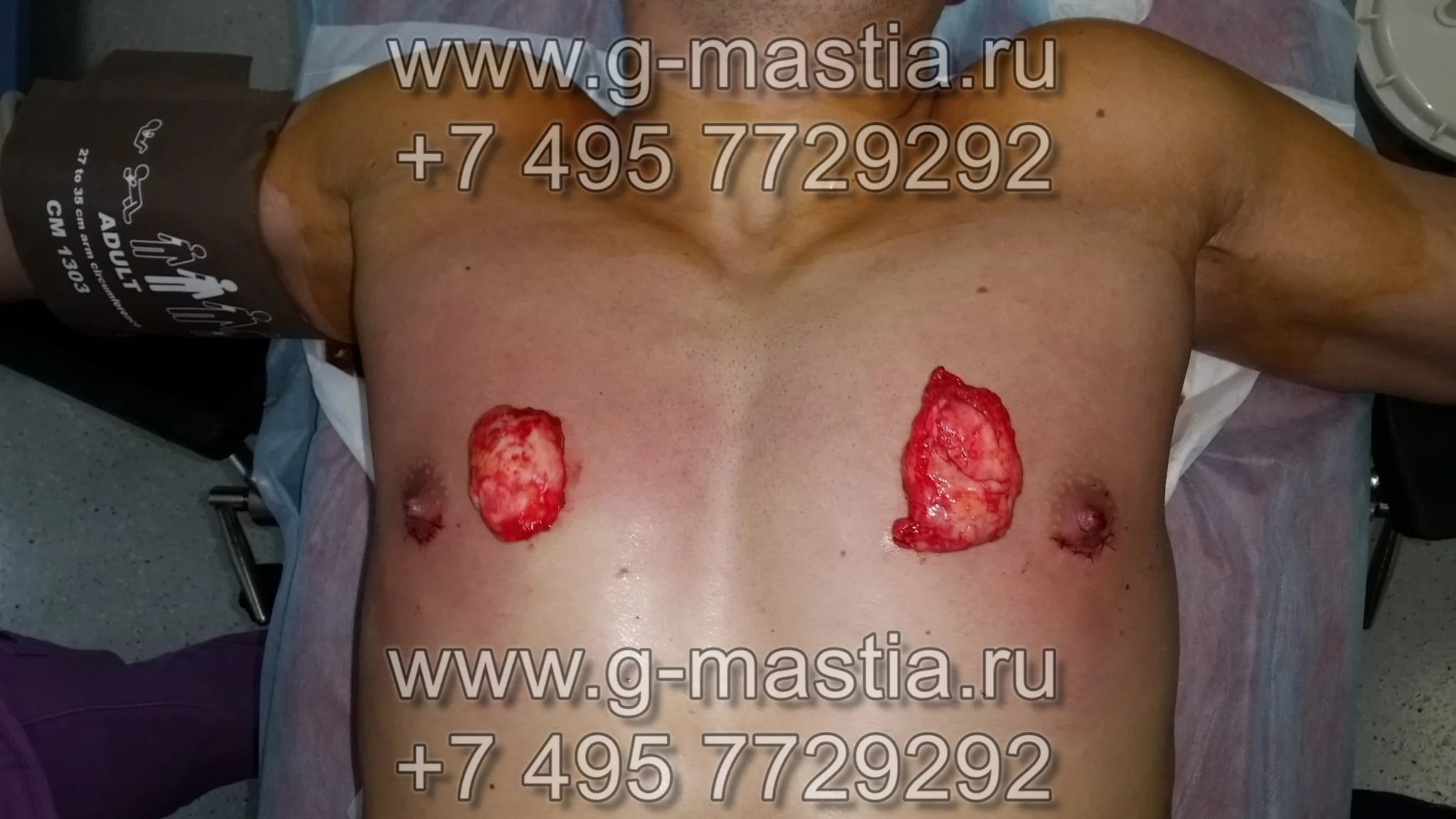 Удалённые грудные железы
