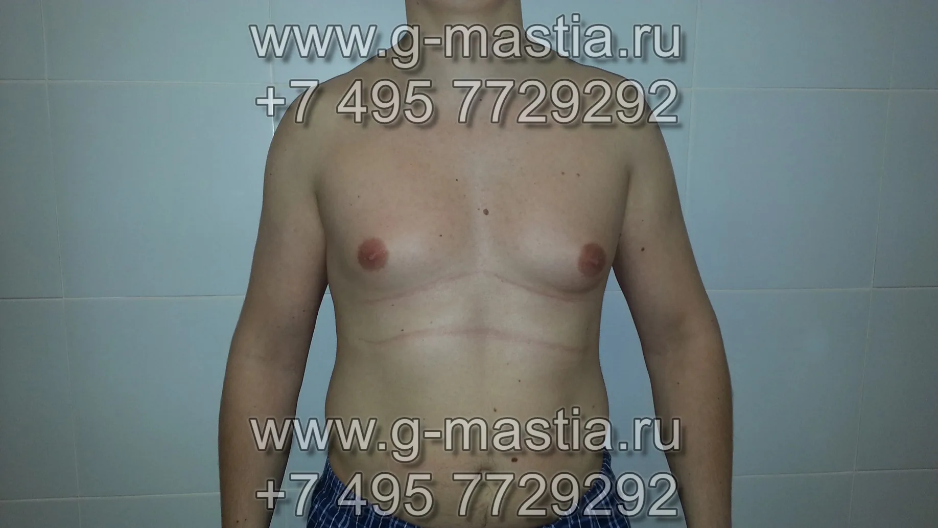 Лечение смешанной формы гинекомастии - липосакция и подкожная мастэктомия