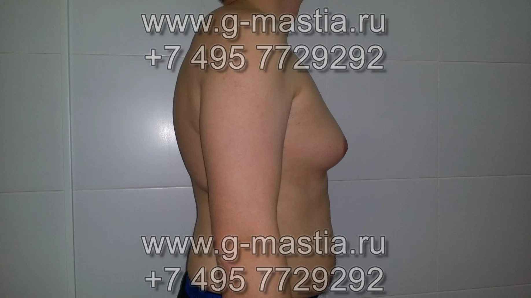 Женская грудь у мужчины