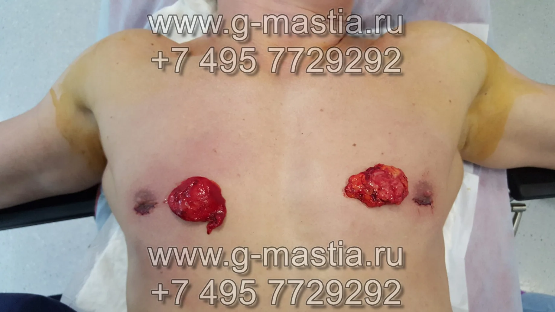 Удалённые грудные железы диаметром около 5 см