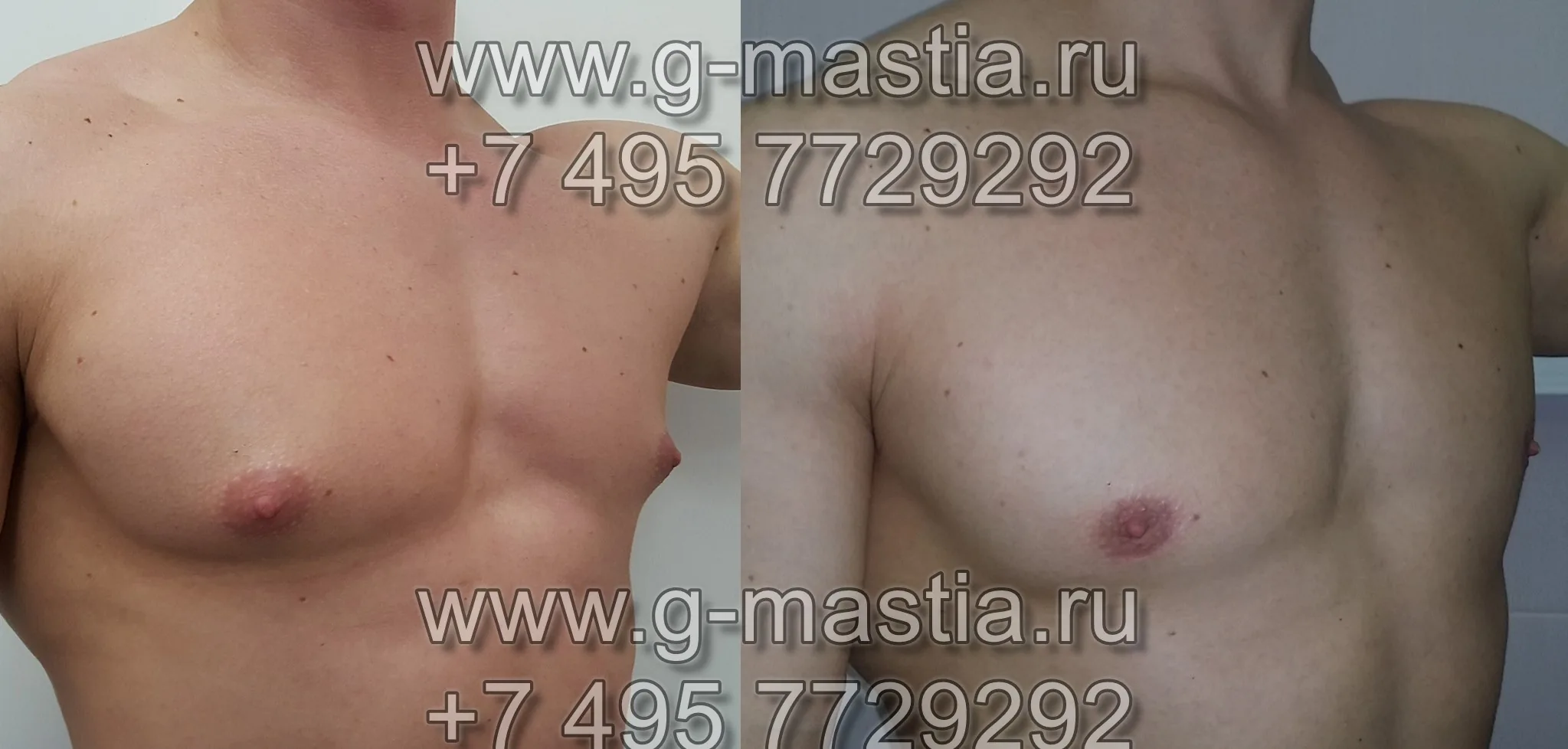 До и после операции через 1 месяц