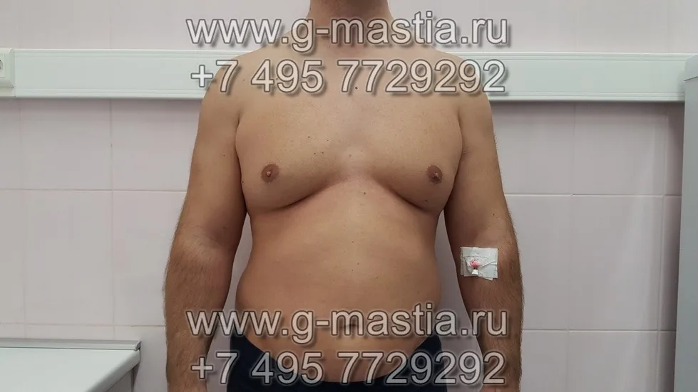Женоподобная форма груди