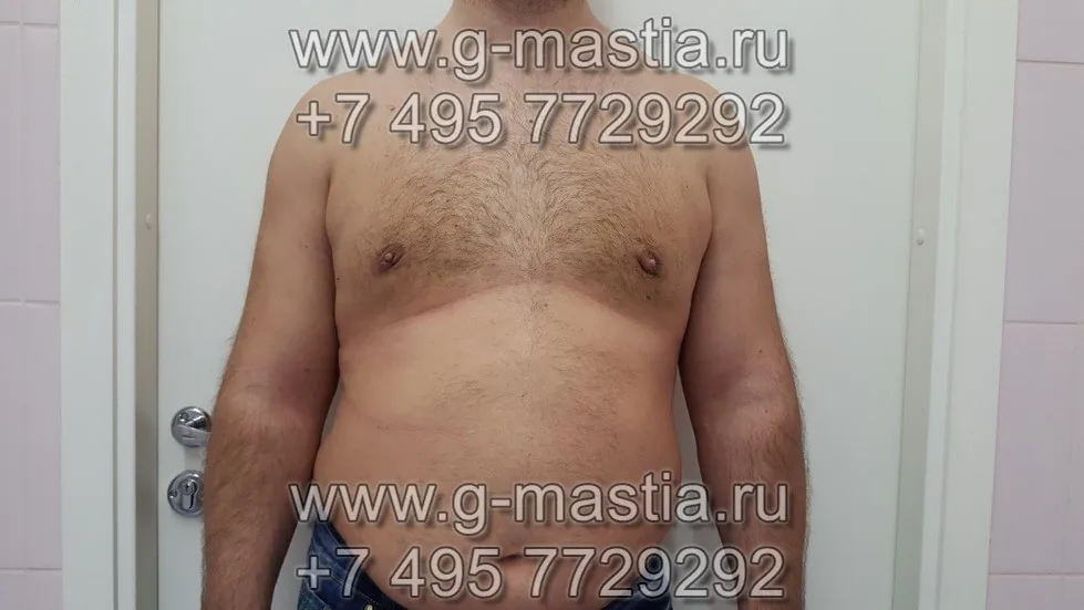 Результат операции через 1 месяц