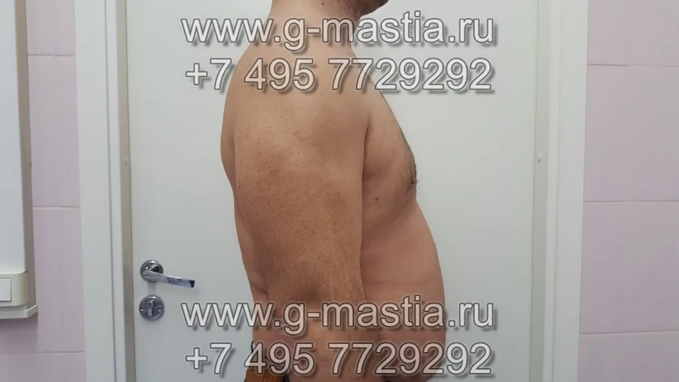 Результат операции через 1 месяц