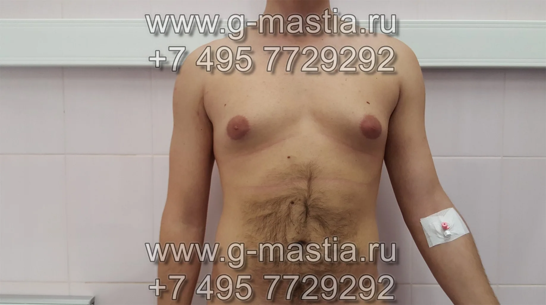 Липосакция и подкожная мастэктомия - лечение смешанной гинекомастии. Результат операции