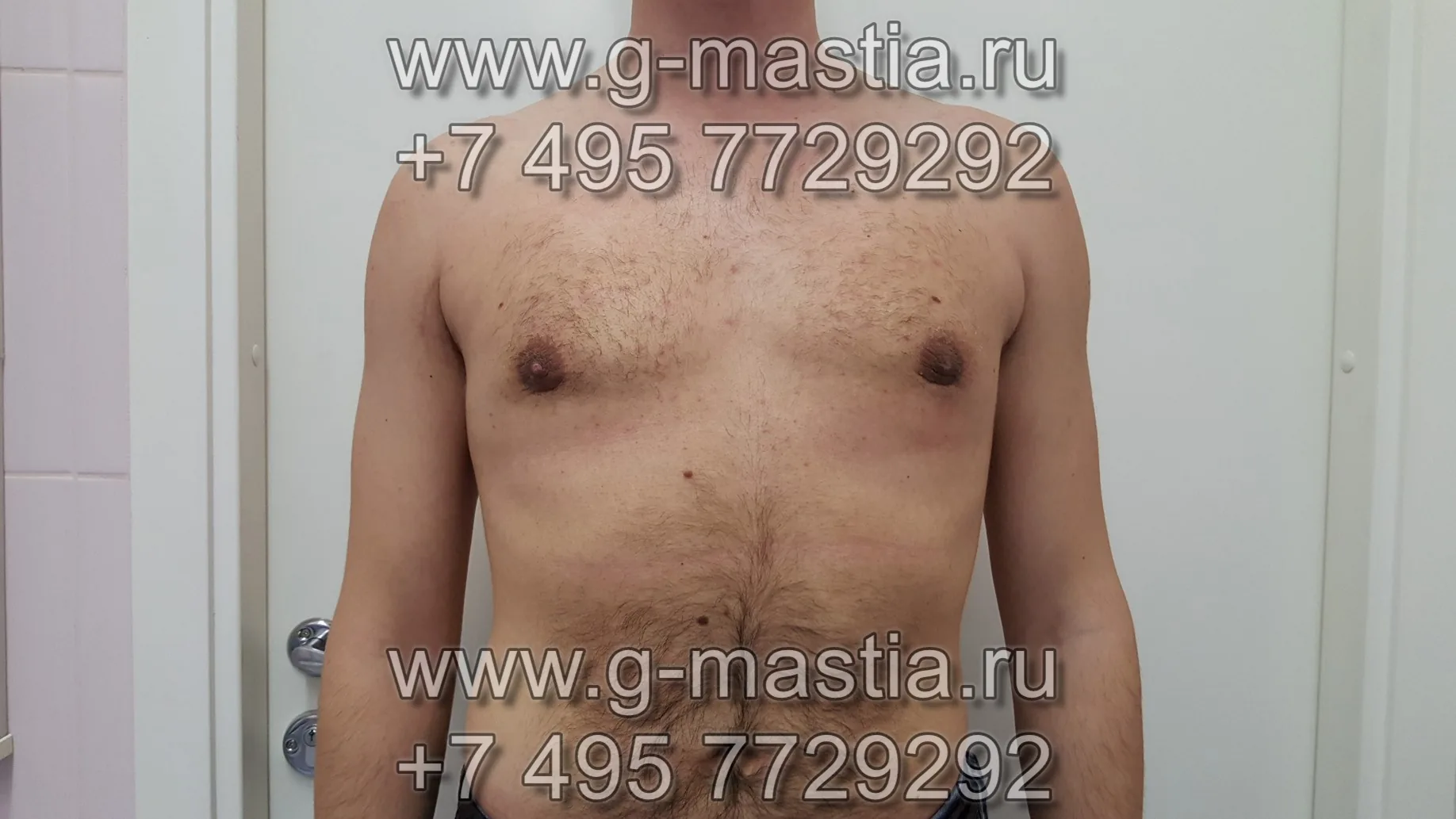 Пациент через месяц после операции