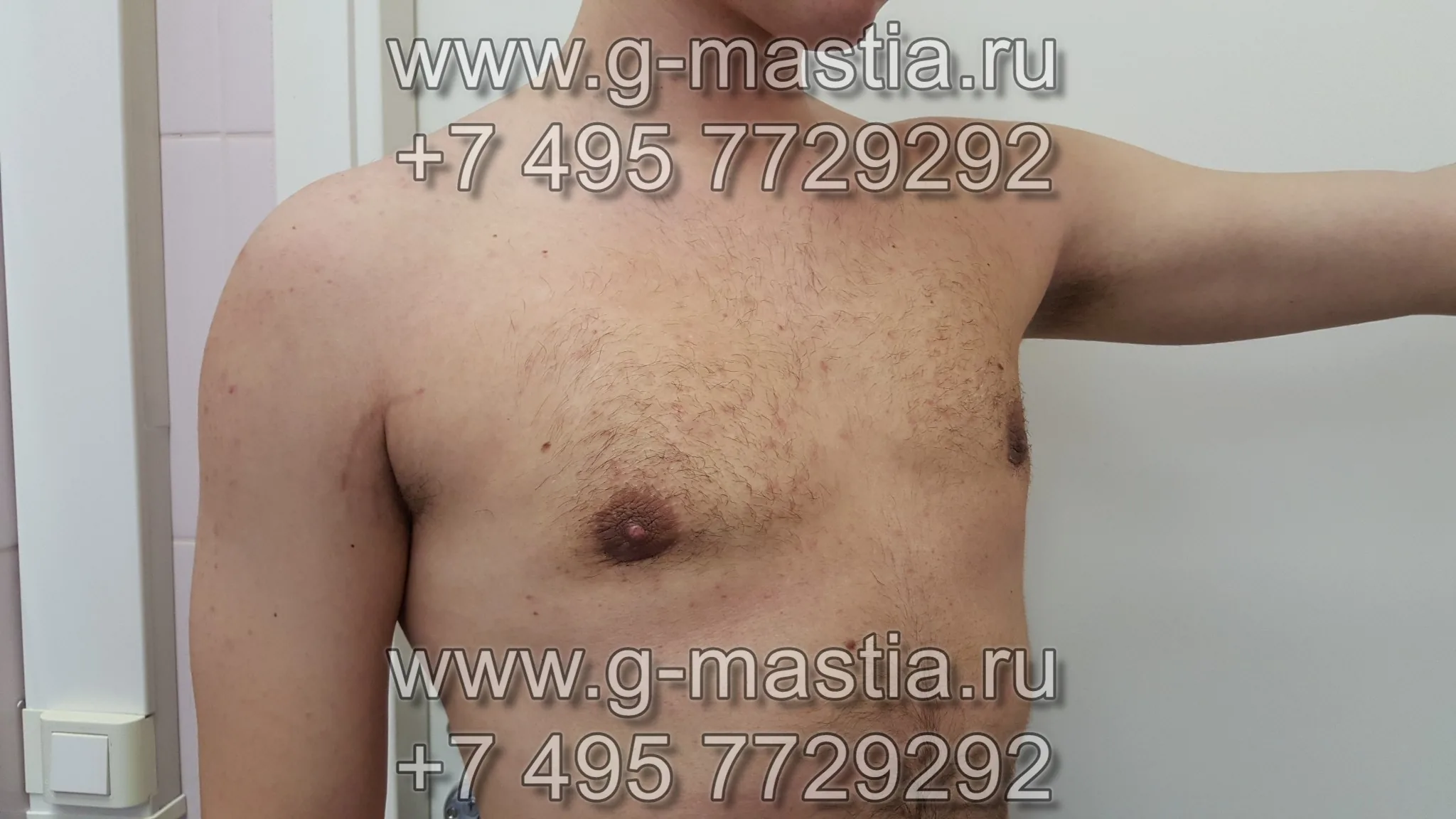 Пациент через месяц после операции