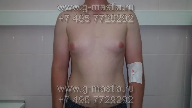 Гинекомастия у мужчин. Результат операции через 1 месяц