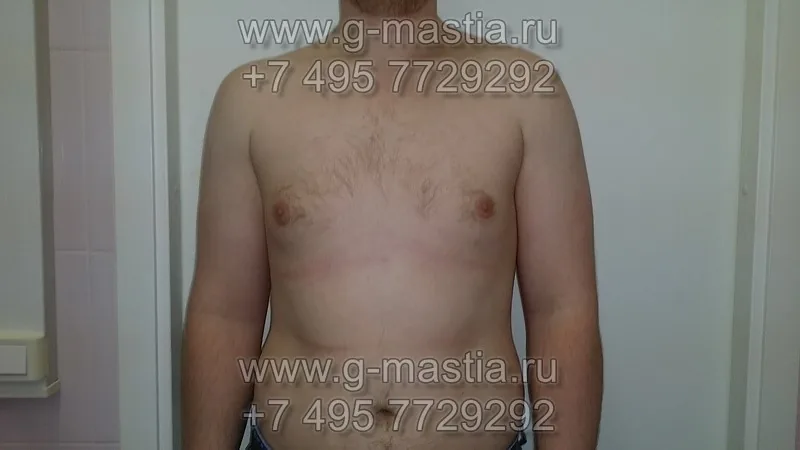 Пациент через 2 месяца после операции