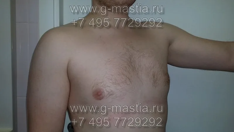 Результат операции через 2 месяца