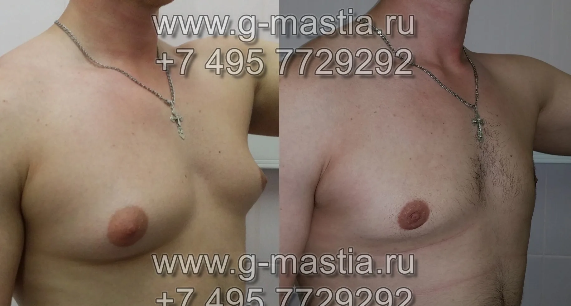 Фото до и после операции