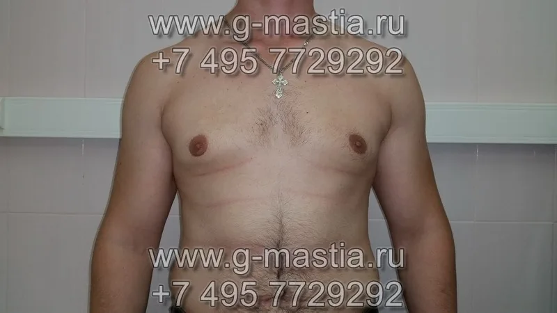 Пациент на осмотре через месяц после операции
