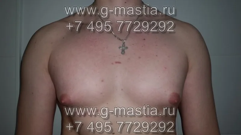 Увеличенные грудные железы и набухшие ареолы сосков