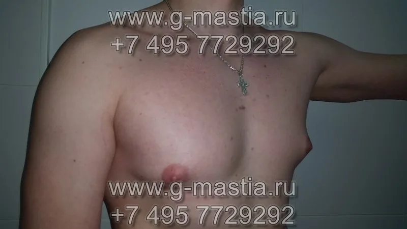 Гинекомастия