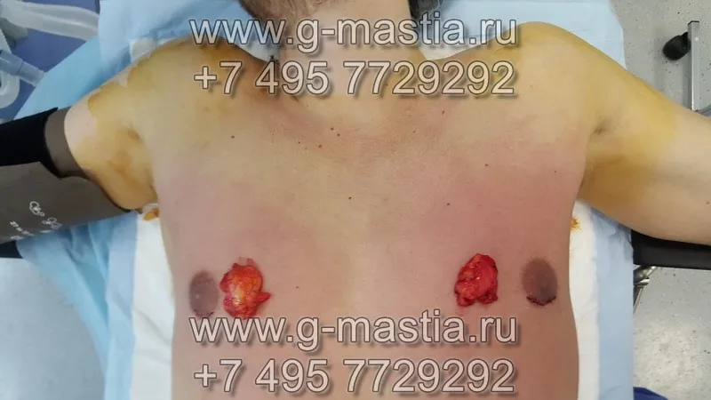 Удалённые грудные железы