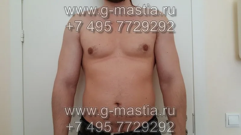 Пациент через 3 месяца после операции