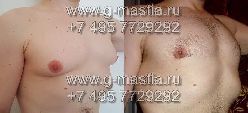 Фото до и после операции через 1,5 месяца