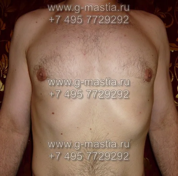 Фото пациента из дома через 1,5 месяца