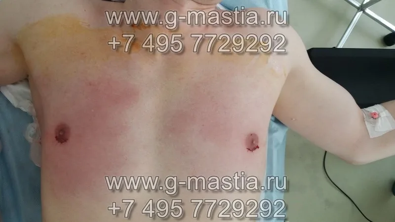 Пациент сразу после операции