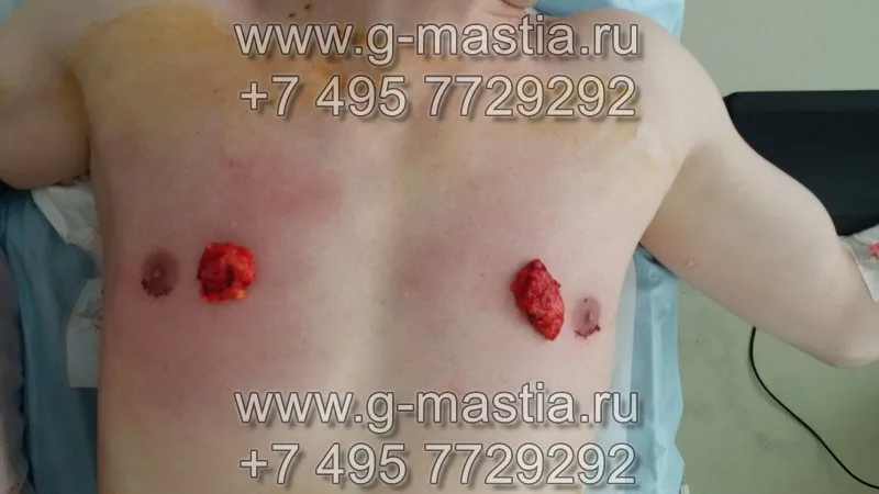Удалённые грудные железы