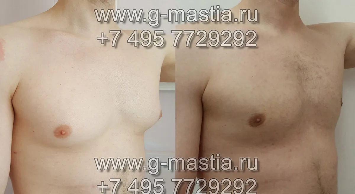 Пациент до и после операции, результат через 1 месяц