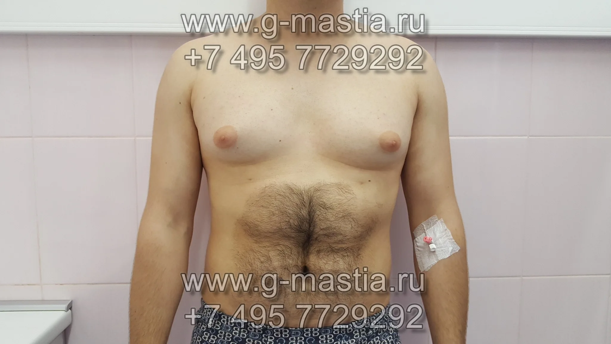 Гинекомастия у мужчины смешанной формы. Результат операции через 20 дней.