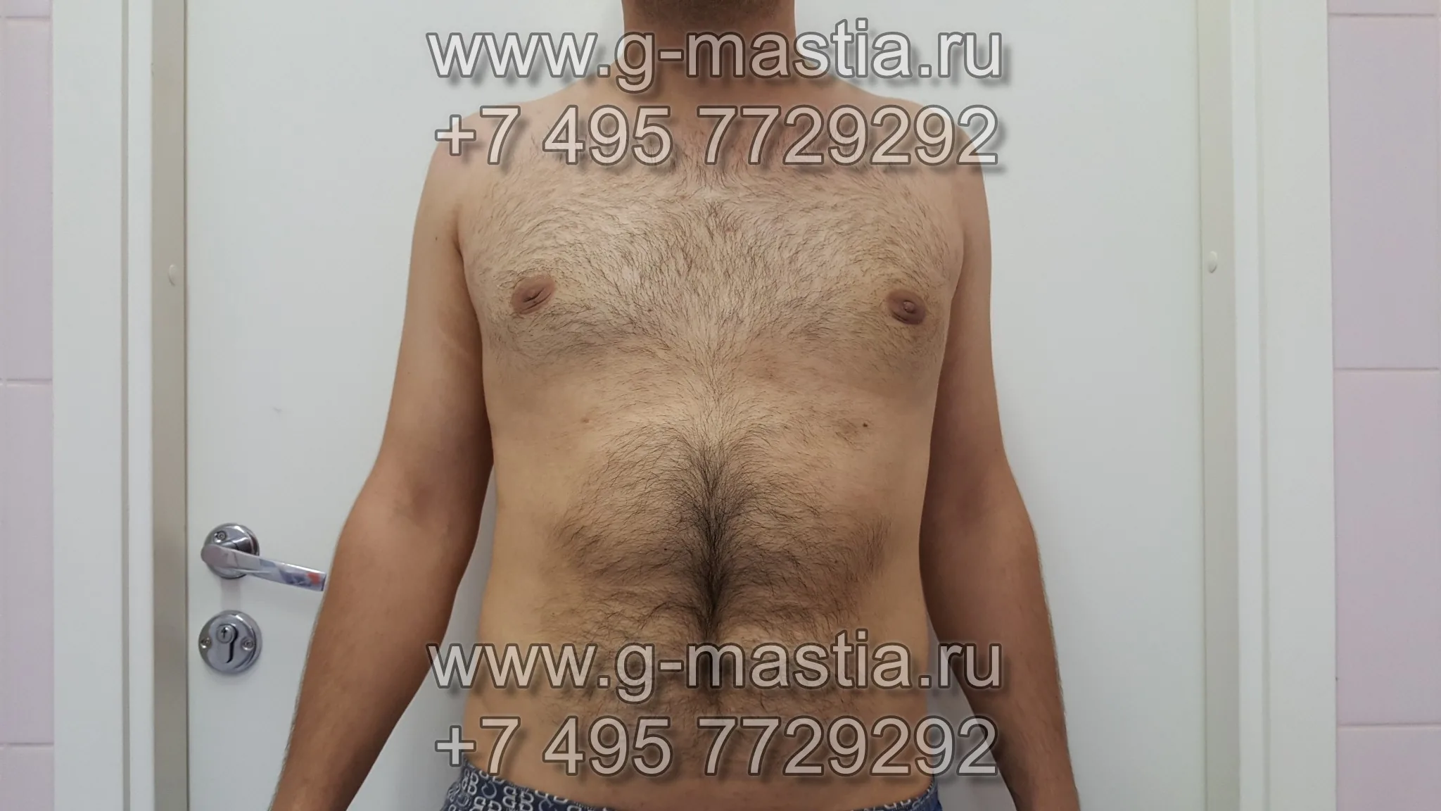 Через 20 дней после операции