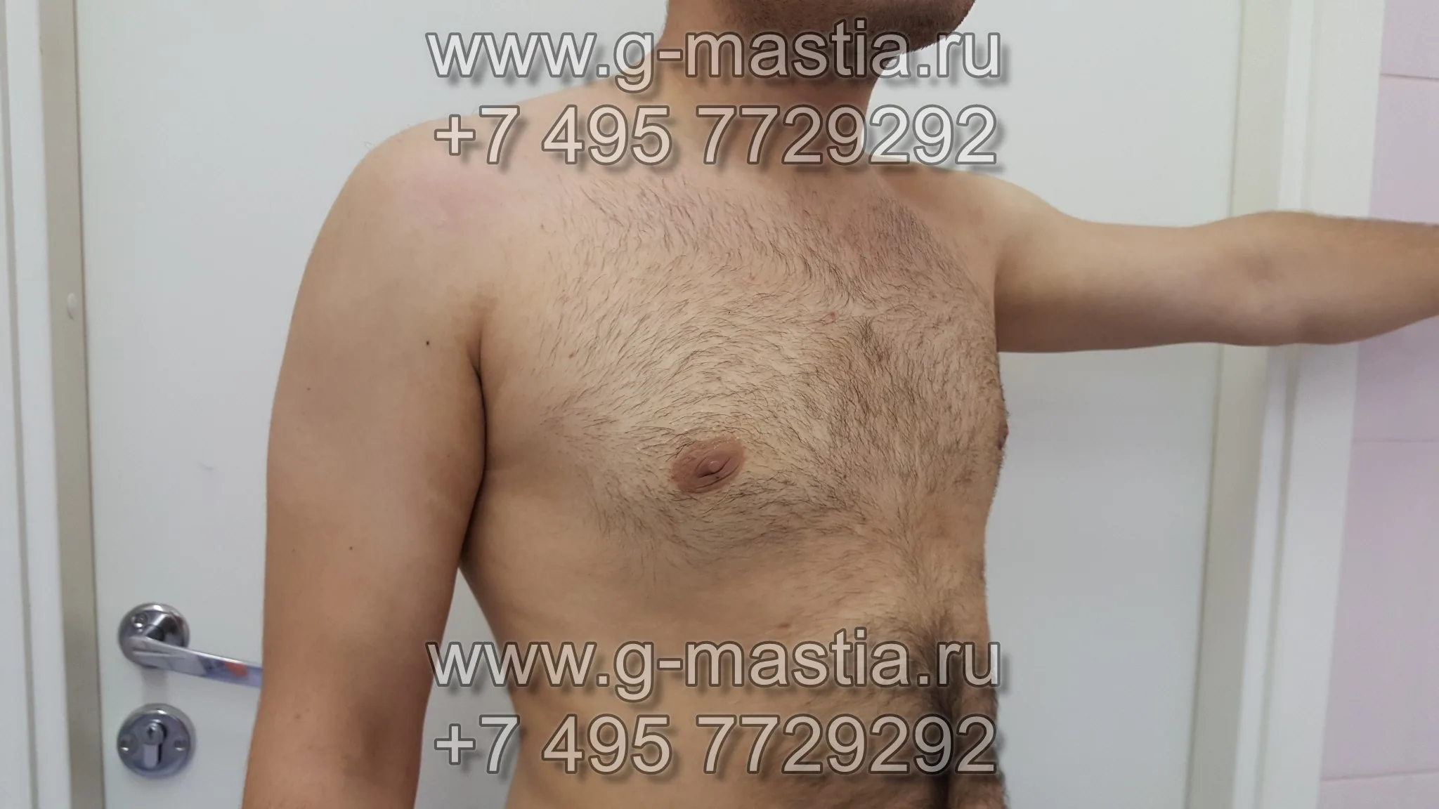 Через 20 дней после операции