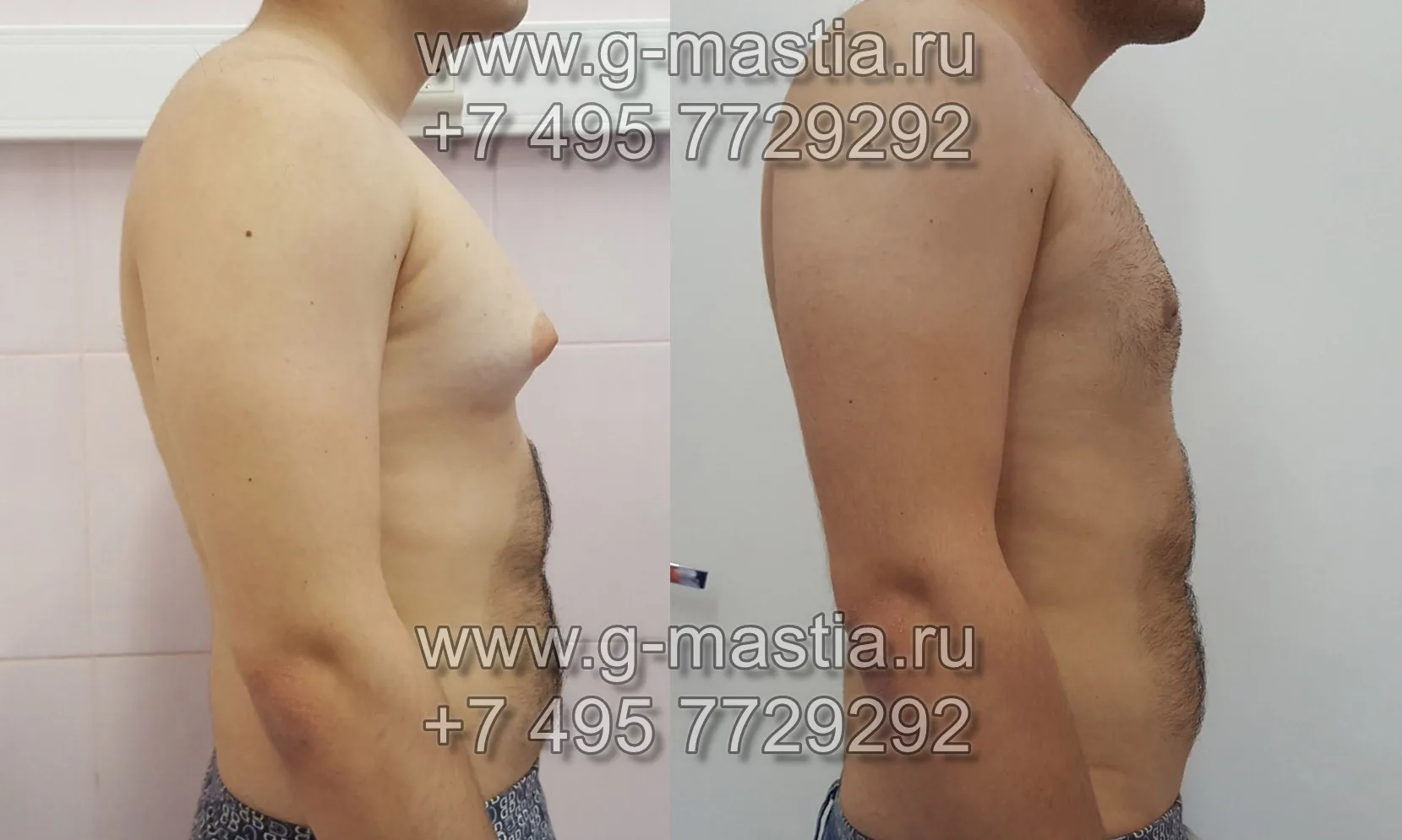 Результат операции по удалению гинекомастии через 20 дней