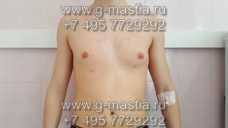 Гинекомастия асимметричной формы