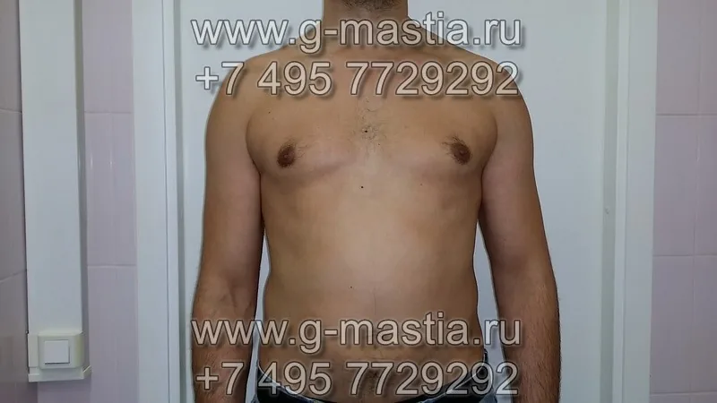 Пациент через 1,5 месяца после операции