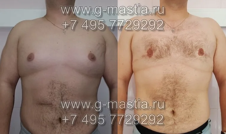 Фото до и после операции
