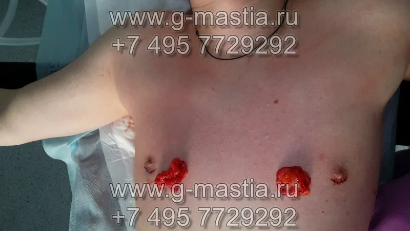Удалённые грудные железы