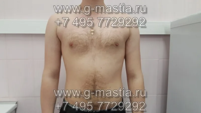 Пациент через 5 месяцев после операции