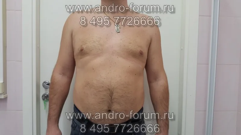 Результат операции через 38 дней