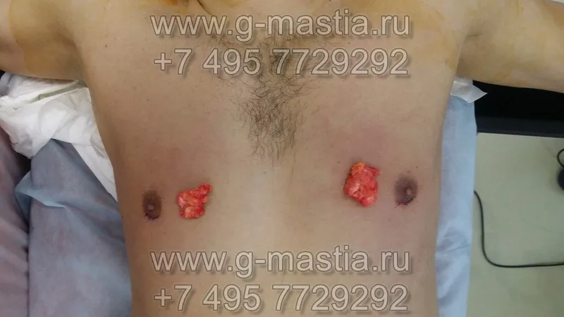 Удалённые грудные железы