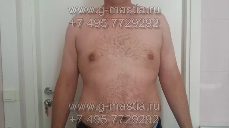 Через 1 месяц на осмотре: кожа сократилась, ареолы сосков уменьшились в размере